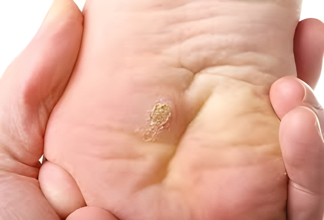 FAQs about corn treatment
